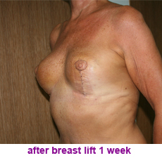 plastic-surgery-breast-lift